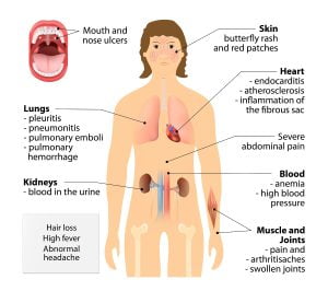 Systemic lupus erythematosu (SLE)