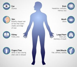 Common symptoms and signs of lupus