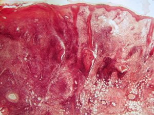 Discoid lupus (skin lesion)