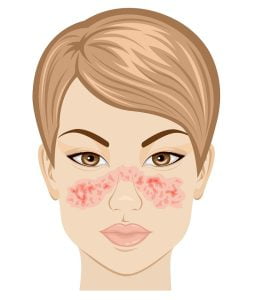 Illustration symptoms of systemic lupus on the face