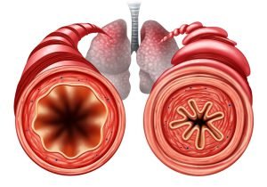 Asthma: Healthy and unhealthy bronchial tube