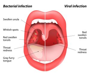 The name 'strep' throat comes from the type of bacteria that is known to cause the infection