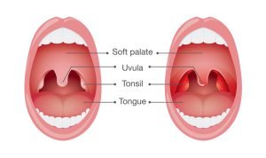 Normal tonsils vs inflamed tonsils