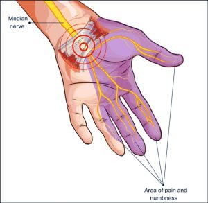 Median Nerve