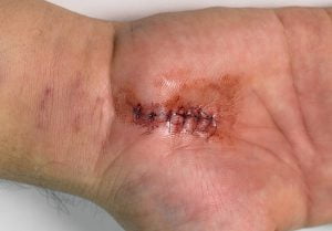 Carpal tunnel syndrome surgery