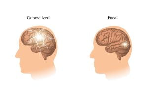 Types of epilepsy