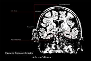 MRI of brain