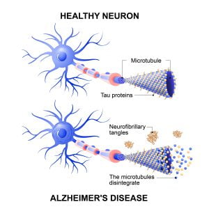 Healthy cell vs neuron with Alzheimer's