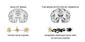 Senile changes of the brain