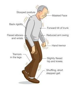 Parkinson's disease symptoms