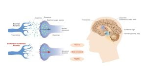 Dopamine levels and Parkinson's disease