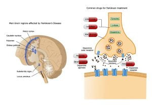 Parkinson's disease - Neurodegeneration and treatment