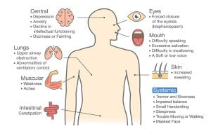 Symptoms and signs of Parkinson's disease