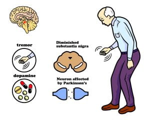 Effects of parkinson's disease