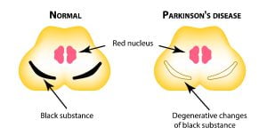 Normal vs a Parkinson's patient brain