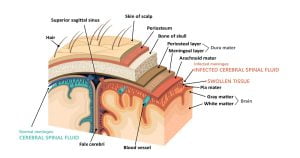 Bacterial meningitis