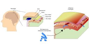 Effect of meningitis
