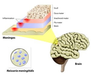 Meningitis - Human brain