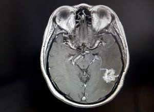 MRI of Brain Tumour