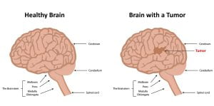 Healthy brain vs brain with a tumor