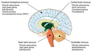 Different types of brain tumors