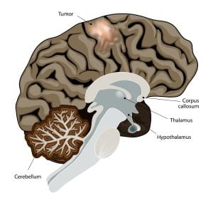 Brain cancer image