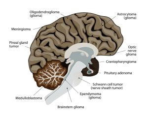 Most common types of brain cancer