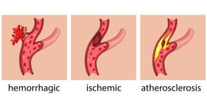 Stroke types