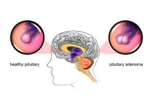 Pituitary adenoma