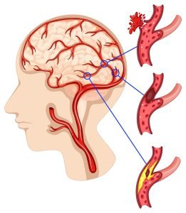 Brain cancer image