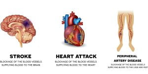 Chronic complications of diabetes