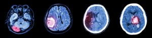 CT scan of brain