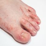 Dermatitis on foot