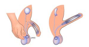 Penile prosthesis
