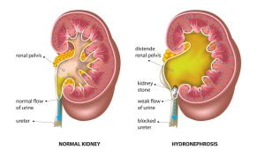 Cause of hydronephrosis- Kidney stone blocked ureter