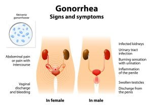 Gonococcol Infection