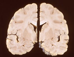 Photomicrograph showing pathologic changes in central nervous system