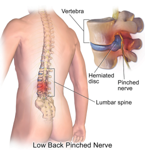 What is a pinched nerve?