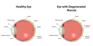 Healthy eye vs eye with macular degeneration (Stargardt Disease)