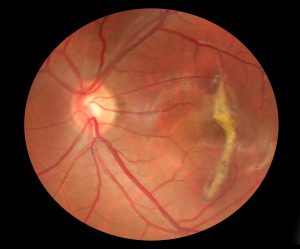Retinal photo with macular degeneration in a patient