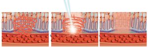 Laser treatment of macula