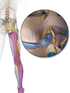 What is sciatica?