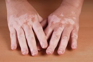 Vitiligo on hands