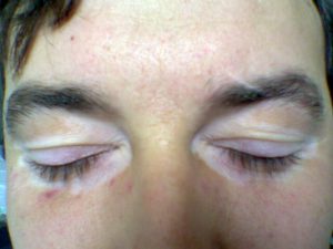 Eyelid vitiligo