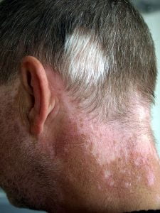 Depigmentation of portions of skin and hair