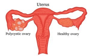 What is an ovarian cyst?