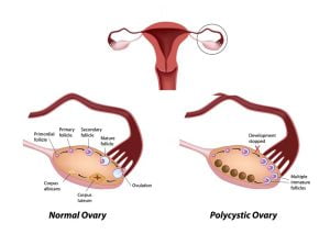 Polycystic ovarian syndrome