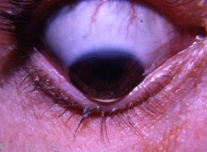 Keratoconus in the eye of a patient