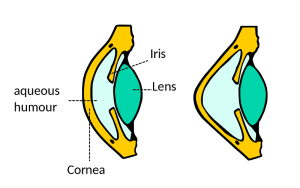 Normal cornea vs keratoconus eye