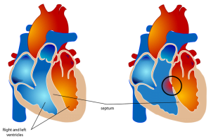 Normal heart vs a heart with ventricular septal defect (VSD)